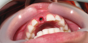 Front tooth implant result Beirut before after