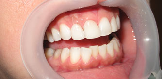 Aesthetic zone dental implant front tooth Beirut Lebanon