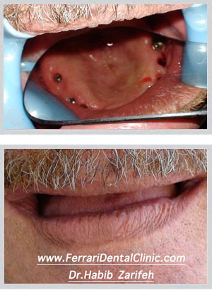 All-on-4 All-on-6 dental implants Beirut Lebanon full arch