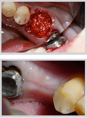 Sinus lift procedure Beirut Lebanon internal external technique