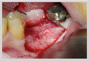 Bone graft dental implants Beirut Lebanon sinus lift procedure