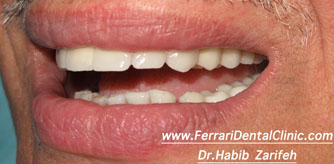 Full mouth dental implants Beirut Lebanon before after result