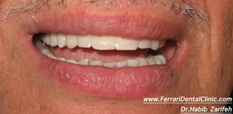 Total dental rehabilitation fixed bridge implants Beirut