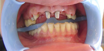 Hollywood smile dental implants Beirut Lebanon before after