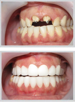 ZEvolution Veneers Hollywood smile Beirut Lebanon Dr Habib Zarifeh