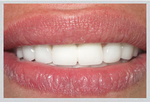 Hollywood smile result Beirut Lebanon cosmetic dentistry implants