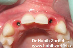Single tooth dental implant Beirut