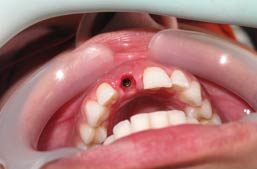 Aesthetic zone dental implants Beirut front teeth