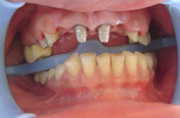 Mini dental implants Beirut Lebanon