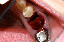 Bone graft dental implants Beirut Lebanon