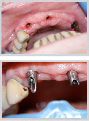 Multiple teeth dental implants Beirut Lebanon by Dr. Habib Zarifeh