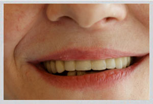 Implant supported bridge multiple teeth Beirut Lebanon