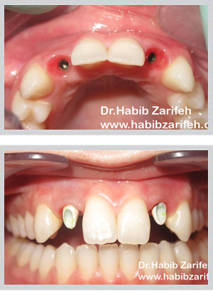 Single tooth dental implant Beirut Lebanon by Dr. Habib Zarifeh